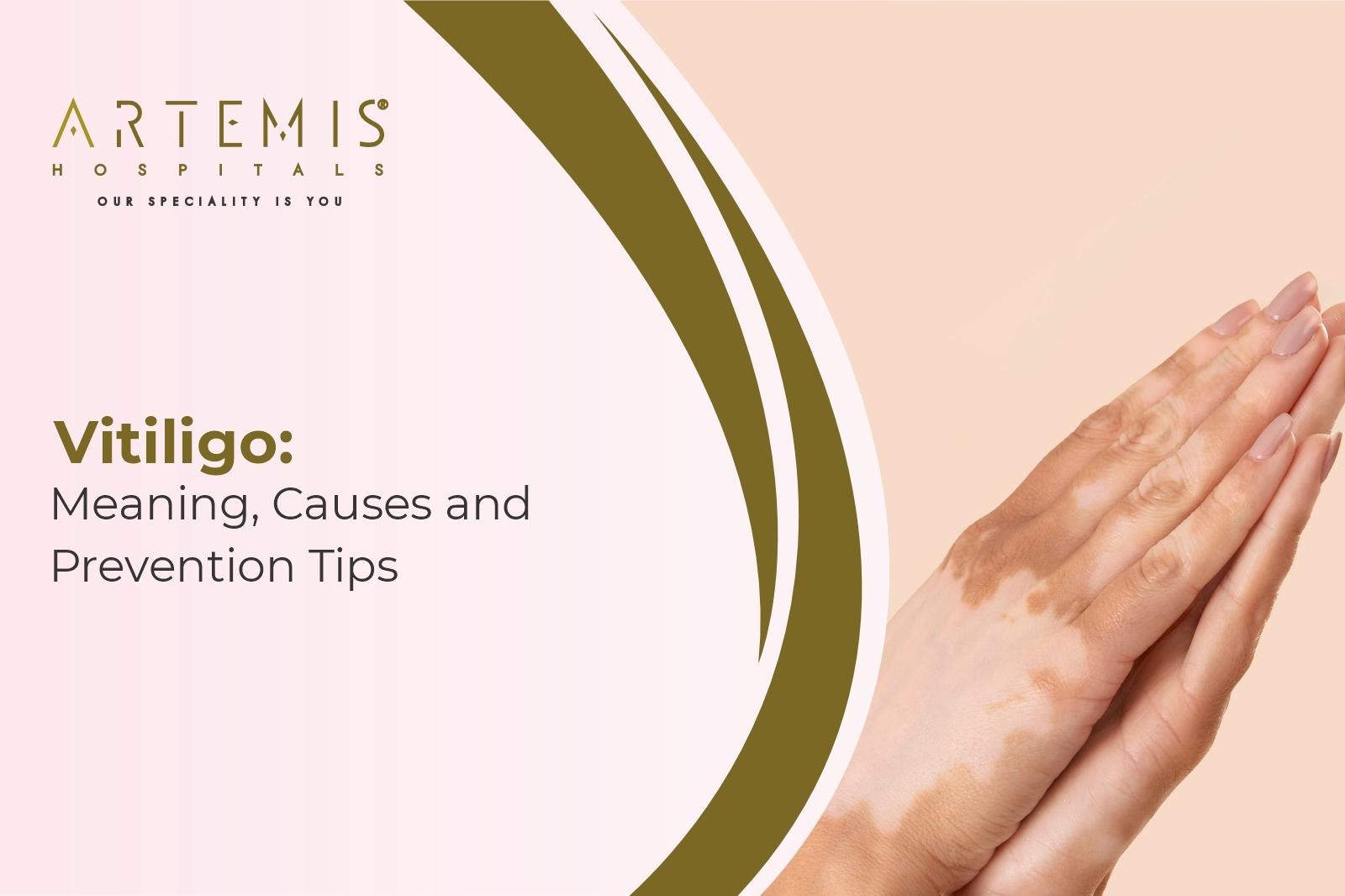 Vitiligo Prevention Tips